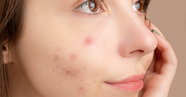 Acne e sole: falsi miti da sfatare